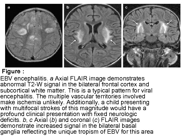 Figure : EBV encephalitis. a Axial FLAIR image demonstrates abnormal T 2 -W signal
