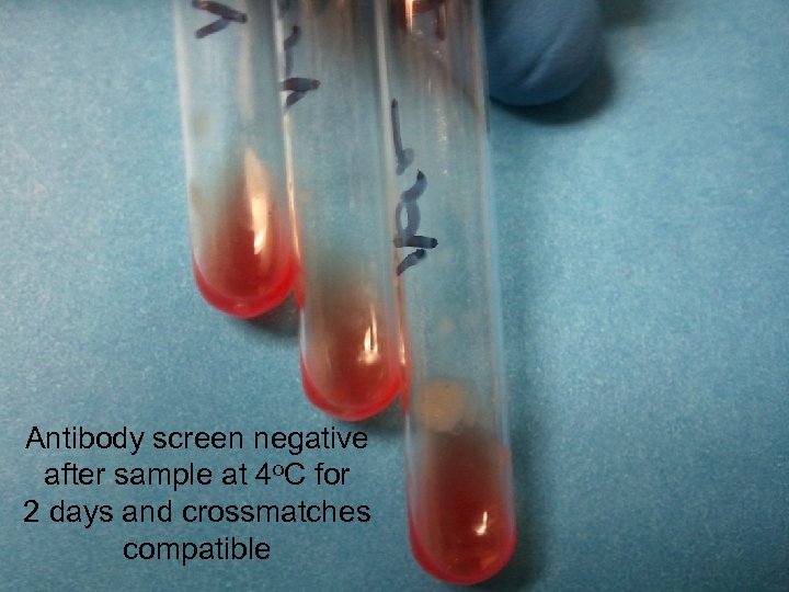 Case 3 Antibody screen negative after sample at 4 o. C for 2 days