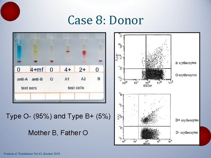 Case 8: Donor 0 4+mf 0 4+ 2+ 0 Type O- (95%) and Type