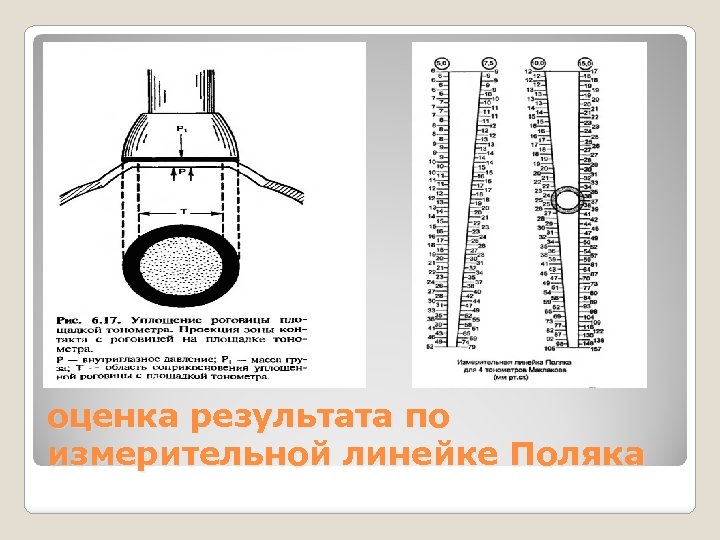 оценка результата по измерительной линейке Поляка 