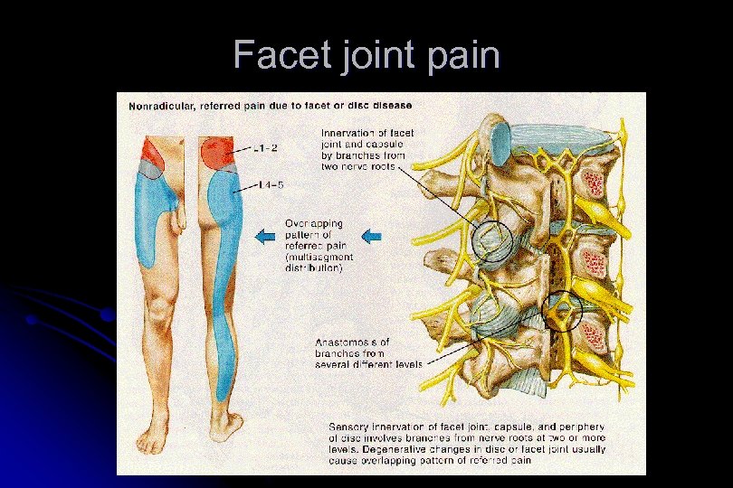 Facet joint pain 