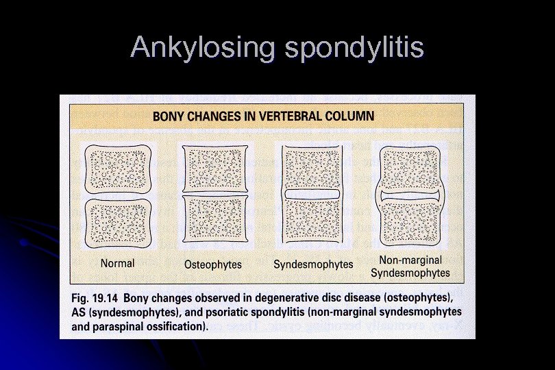 Ankylosing spondylitis 