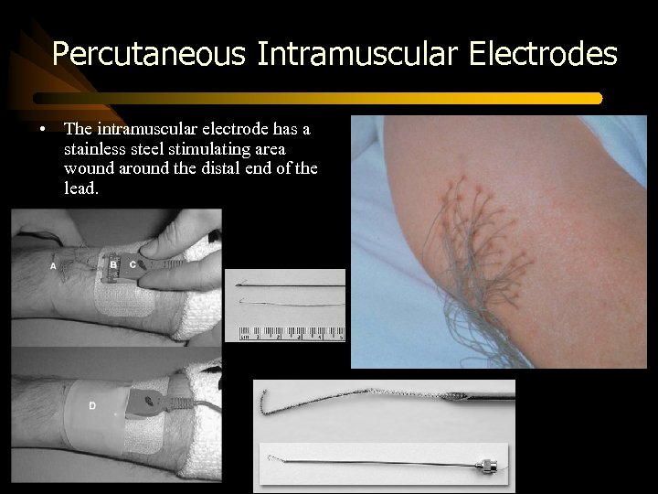 Percutaneous Intramuscular Electrodes • The intramuscular electrode has a stainless steel stimulating area wound