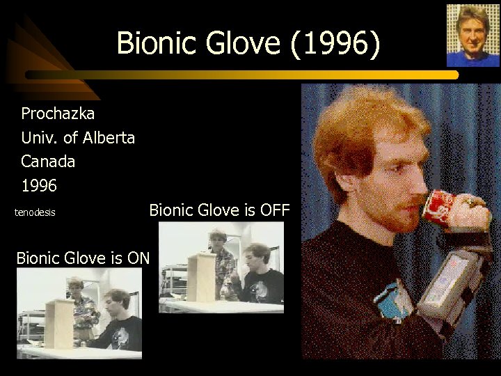 Bionic Glove (1996) Prochazka Univ. of Alberta Canada 1996 tenodesis Bionic Glove is OFF
