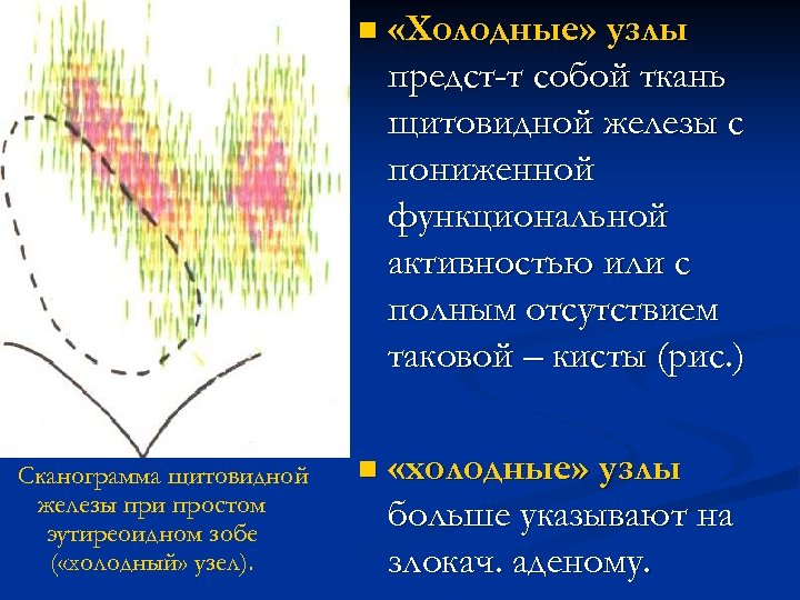 n «Холодные» узлы предст-т собой ткань щитовидной железы с пониженной функциональной активностью или с