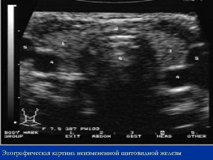 Эхографическая картина неизмененной щитовидной железы 
