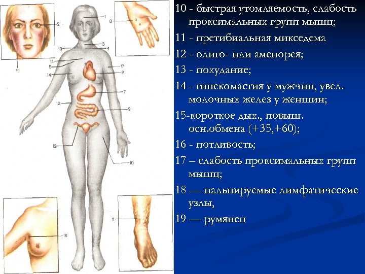 10 - быстрая утомляемость, слабость проксимальных групп мышц; 11 - претибиальная микседема 12 -