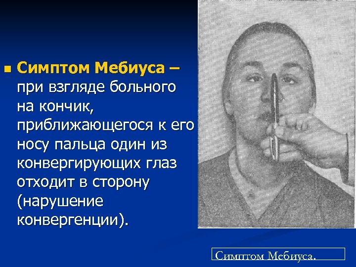n Симптом Мебиуса – при взгляде больного на кончик, приближающегося к его носу пальца
