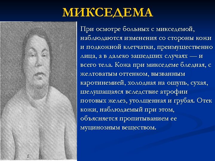 МИКСЕДЕМА n При осмотре больных с микседемой, наблюдаются изменения со стороны кожи и подкожной