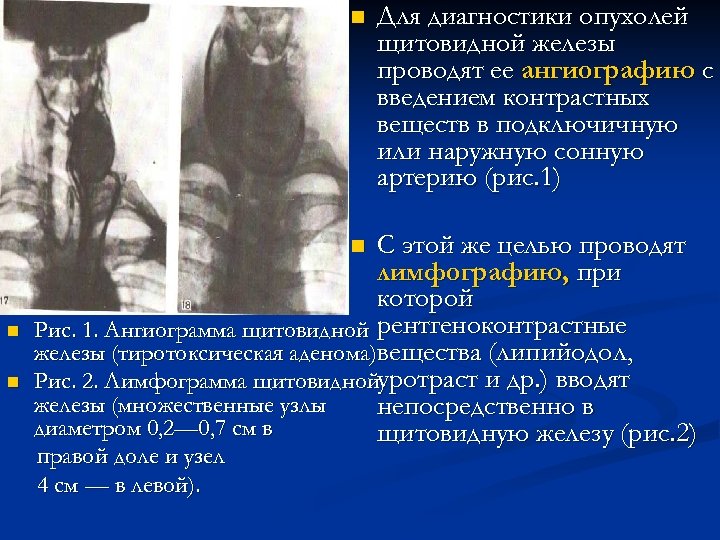n С этой же целью проводят лимфографию, при которой Рис. 1. Ангиограмма щитовидной рентгеноконтрастные