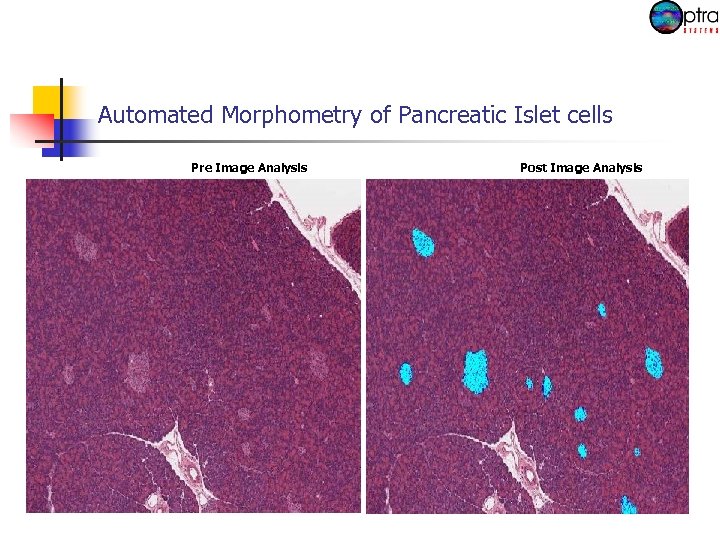 Automated Morphometry of Pancreatic Islet cells Pre Image Analysis Cellularity: Normocellular Area/Size : Normal