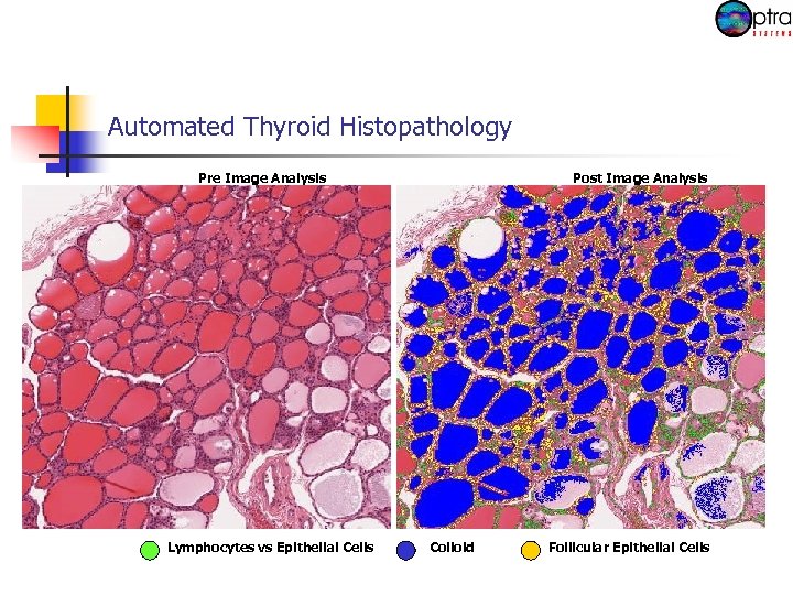 Automated Thyroid Histopathology Pre Image Analysis Lymphocytes vs Epithelial Cells Post Image Analysis Colloid