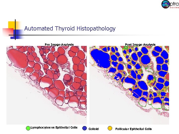 Automated Thyroid Histopathology Pre Image Analysis Lymphocytes vs Epithelial Cells Post Image Analysis Colloid