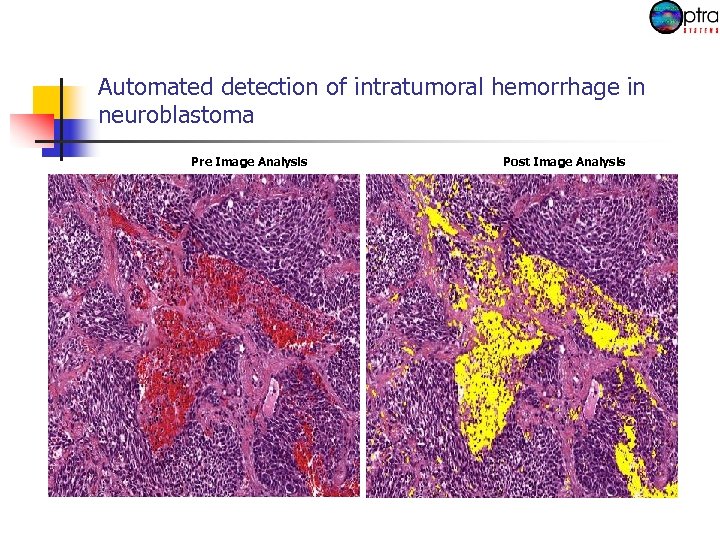 Automated detection of intratumoral hemorrhage in neuroblastoma Pre Image Analysis Post Image Analysis 