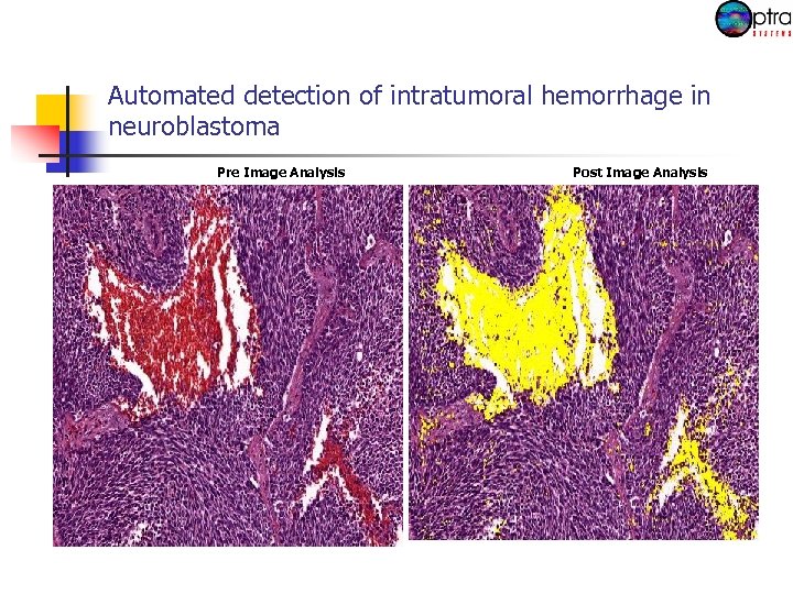 Automated detection of intratumoral hemorrhage in neuroblastoma Pre Image Analysis Post Image Analysis 