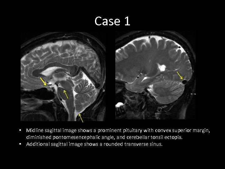 Case 1 • Midline sagittal image shows a prominent pituitary with convex superior margin,