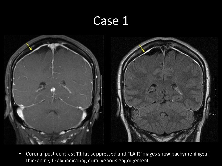 Case 1 • Coronal post-contrast T 1 fat-suppressed and FLAIR images show pachymeningeal thickening,