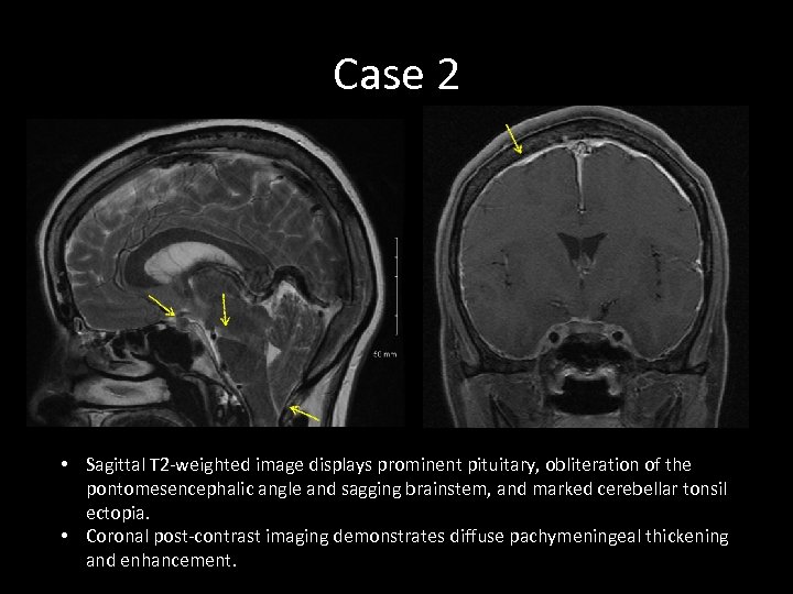 Case 2 • Sagittal T 2 -weighted image displays prominent pituitary, obliteration of the