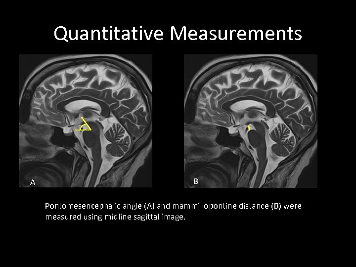 Quantitative Measurements A B Pontomesencephalic angle (A) and mammillopontine distance (B) were measured using