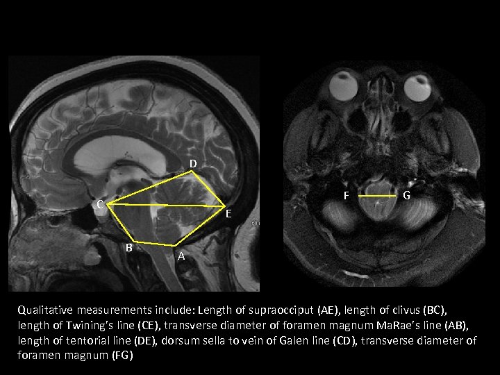 D F C G E B A Qualitative measurements include: Length of supraocciput (AE),