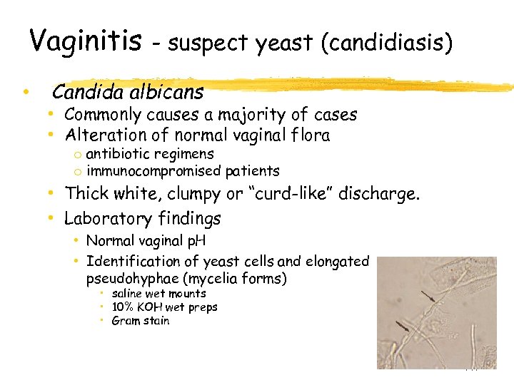 Vaginitis • - suspect yeast (candidiasis) Candida albicans • Commonly causes a majority of