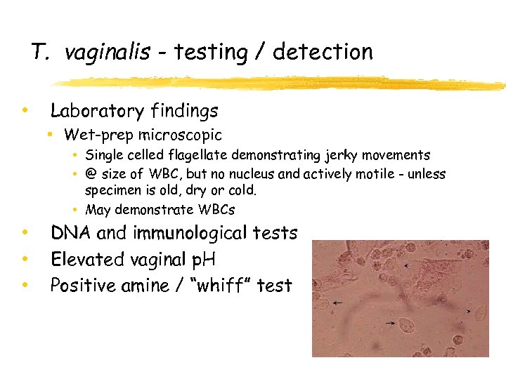 T. vaginalis - testing / detection • Laboratory findings • Wet-prep microscopic • Single