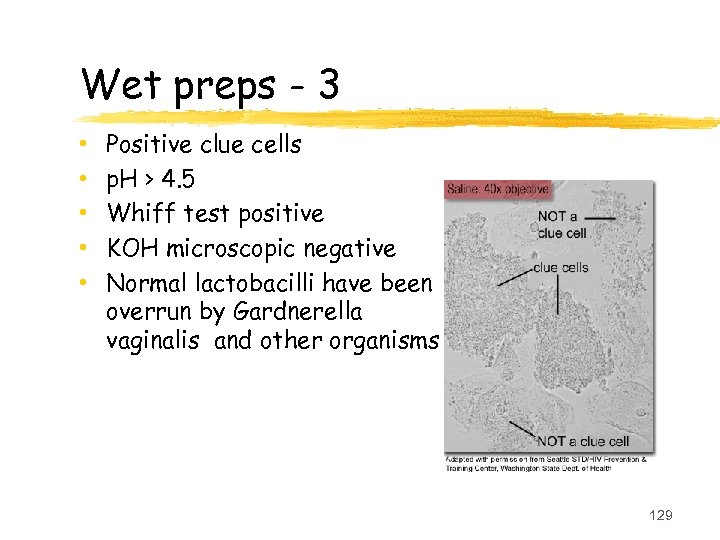 Wet preps - 3 • • • Positive clue cells p. H > 4.