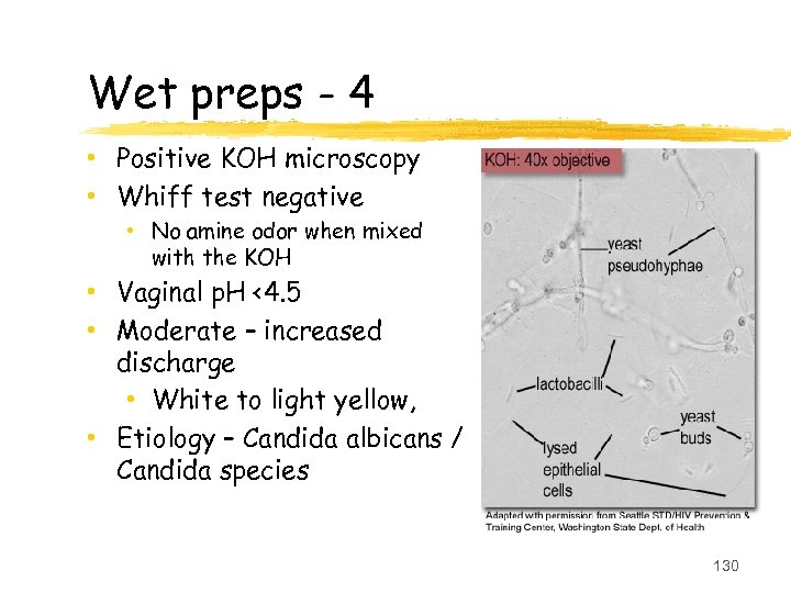 Wet preps - 4 • Positive KOH microscopy • Whiff test negative • No