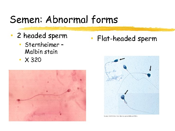 Semen: Abnormal forms • 2 headed sperm • Sternheimer – Malbin stain • X