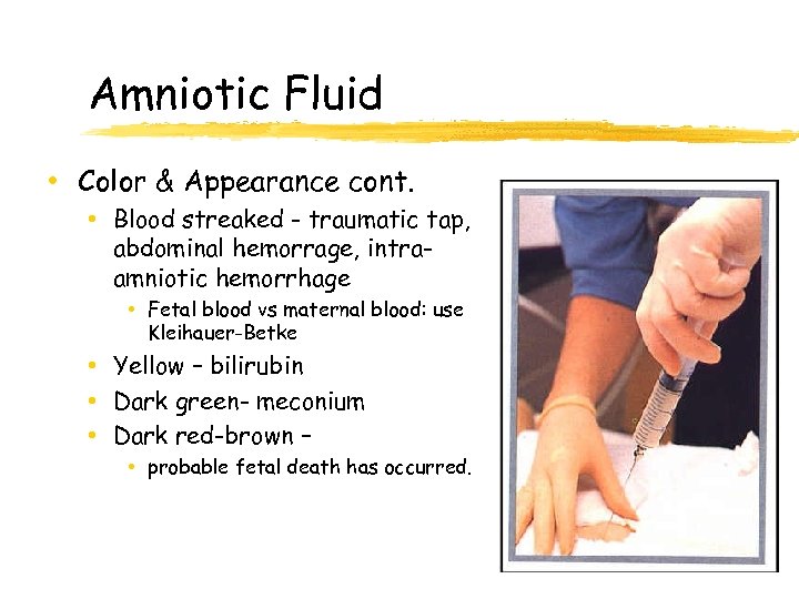 Amniotic Fluid • Color & Appearance cont. • Blood streaked - traumatic tap, abdominal