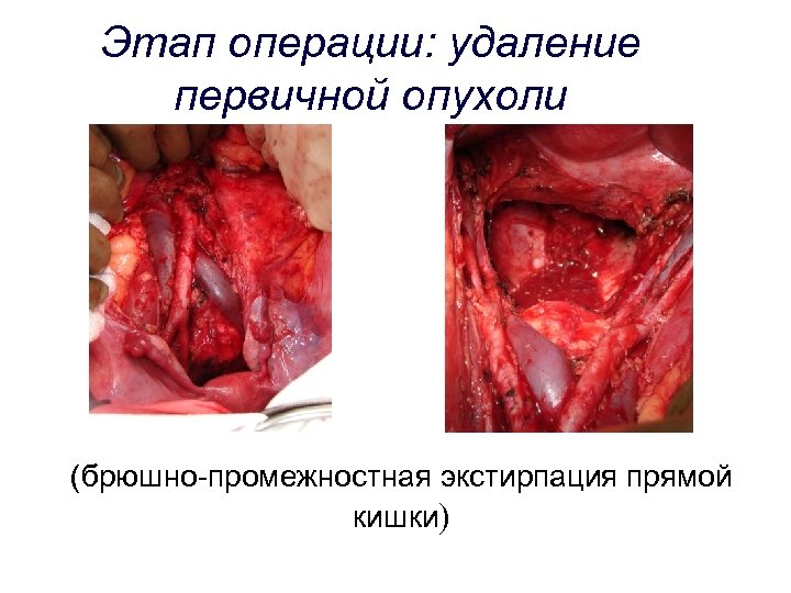 Этап операции: удаление первичной опухоли (брюшно-промежностная экстирпация прямой кишки) 