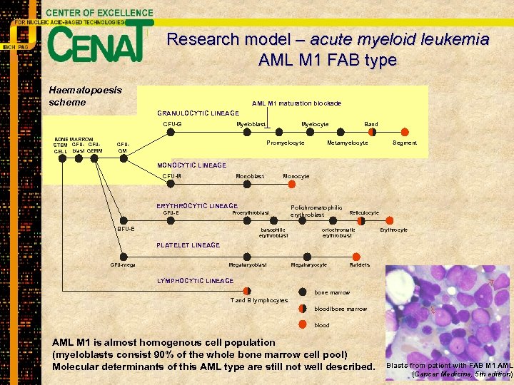 Research model – acute myeloid leukemia AML M 1 FAB type Haematopoesis scheme AML