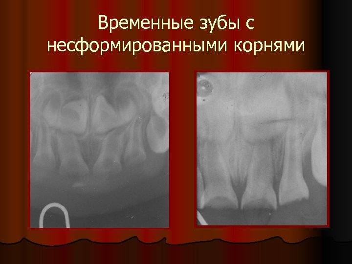 Временные зубы с несформированными корнями 