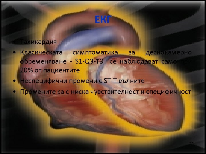 ЕКГ • Тахикардия • Класическата симптоматика за деснокамерно обременяване - S 1 -Q 3