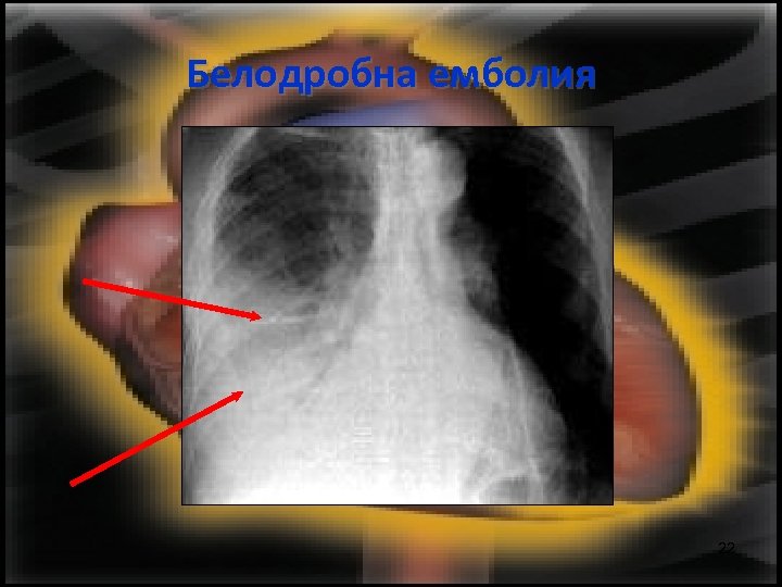 Белодробна емболия 22 