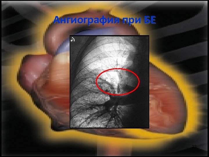 Ангиография при БЕ 23 