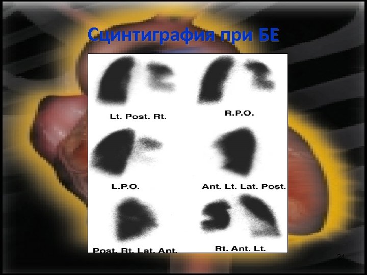 Сцинтиграфия при БЕ 24 