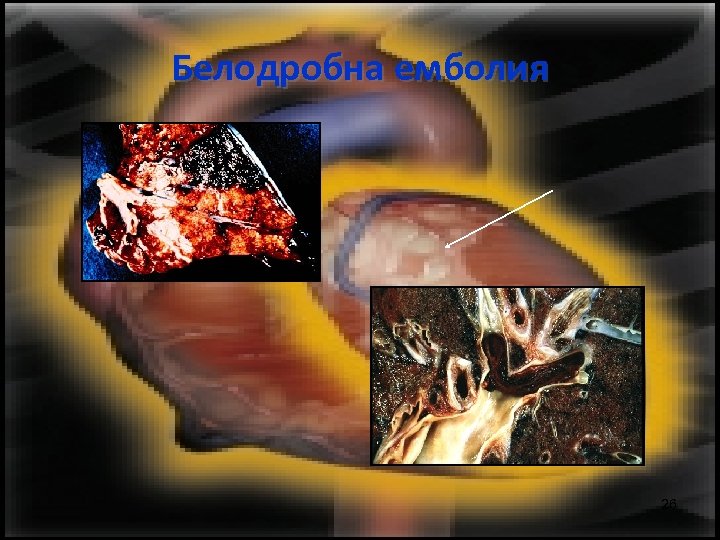 Белодробна емболия 26 