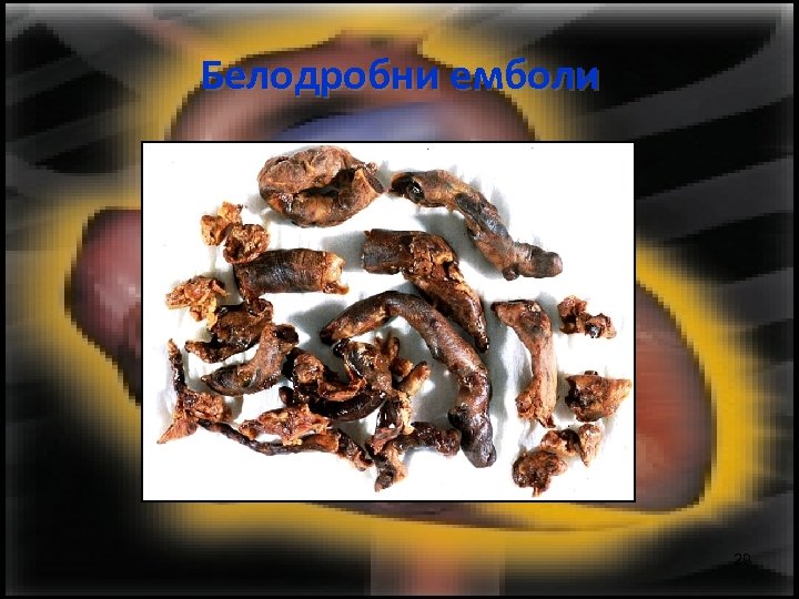 Белодробни емболи 29 