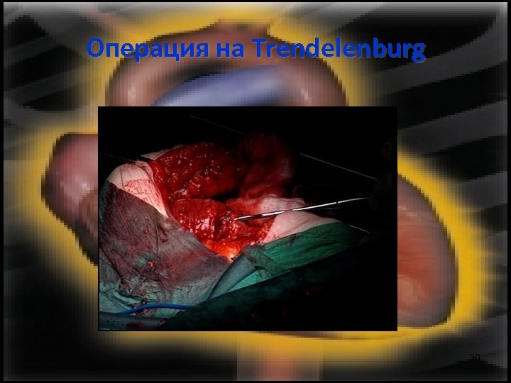 Операция на Trendelenburg 30 