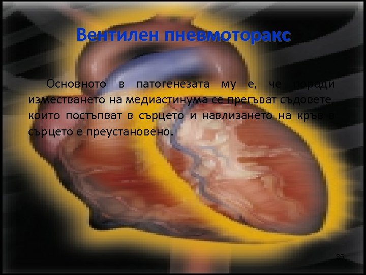 Вентилен пневмоторакс Основното в патогенезата му е, че поради изместването на медиастинума се прегъват