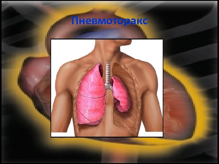 Пневмоторакс 36 