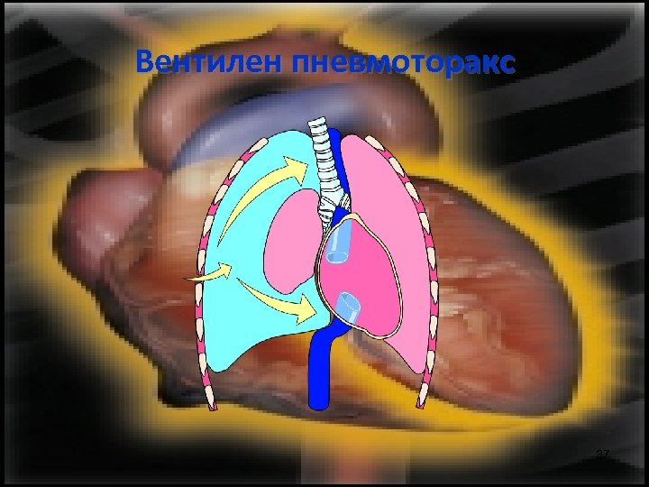 Вентилен пневмоторакс 37 