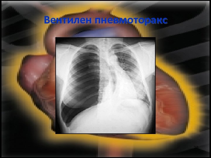 Вентилен пневмоторакс 38 
