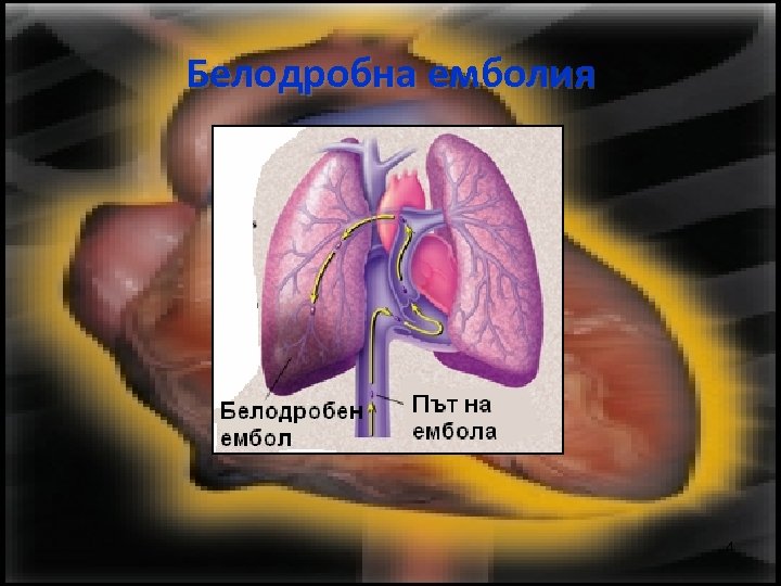 Белодробна емболия 4 