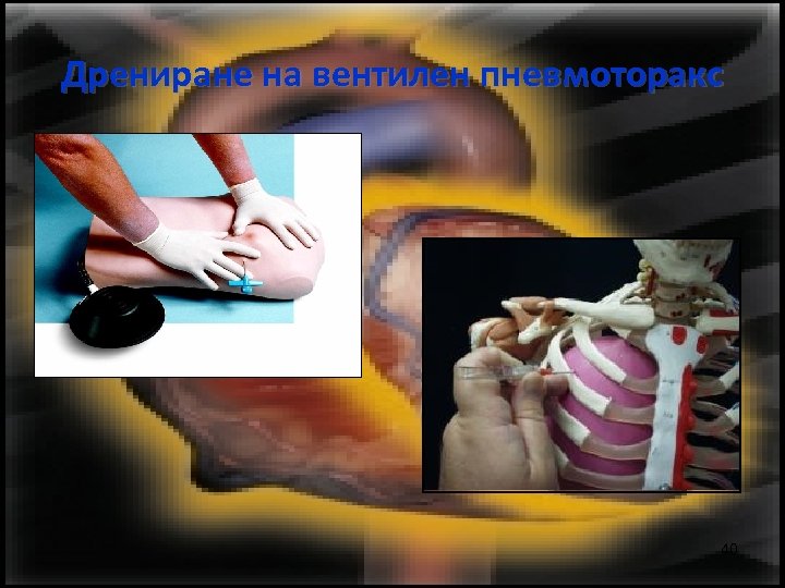 Дрениране на вентилен пневмоторакс 40 