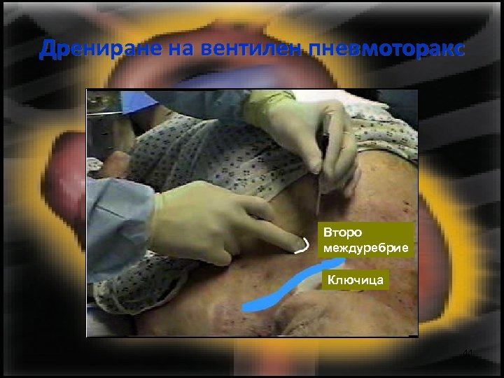 Дрениране на вентилен пневмоторакс Второ междуребрие Ключица 41 