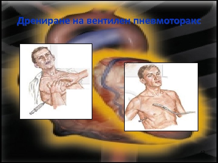 Дрениране на вентилен пневмоторакс 42 