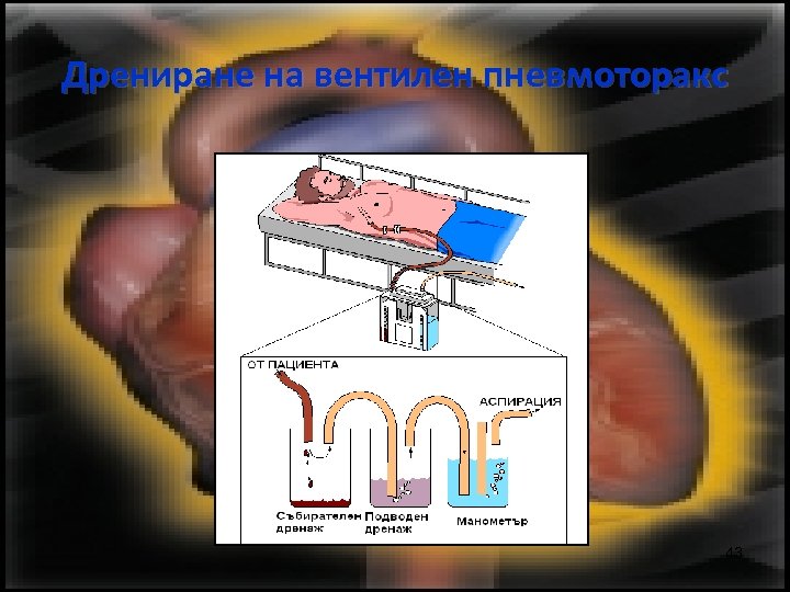 Дрениране на вентилен пневмоторакс 43 