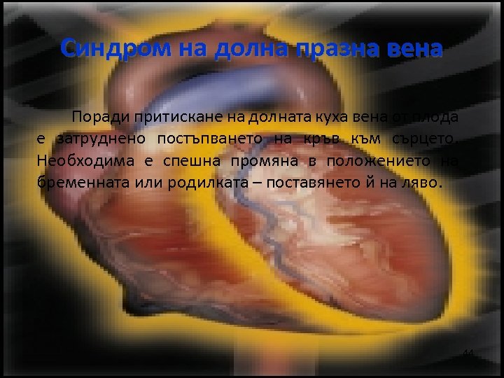 Синдром на долна празна вена Поради притискане на долната куха вена от плода е